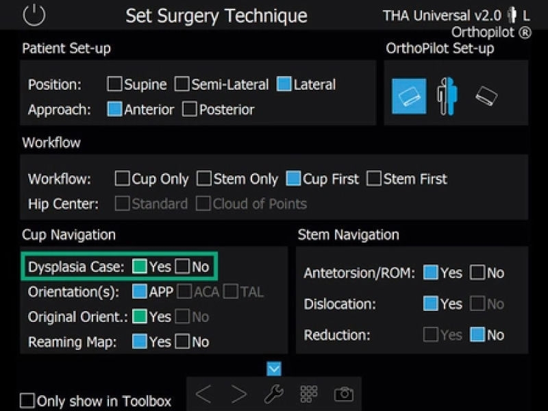 THA Dysplasia ナビゲーションソフトウェアの股関節形成術のスクリーンショット